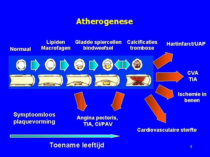 Atherogenese Normaal Lipiden Gladde spiercellen Calcificaties Macrofagen bindweefsel trombose Hartinfarct/UAP CVA TIA Ischemie in