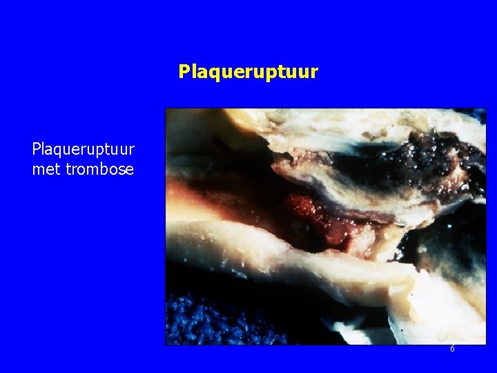 Plaqueruptuur met trombose 6 