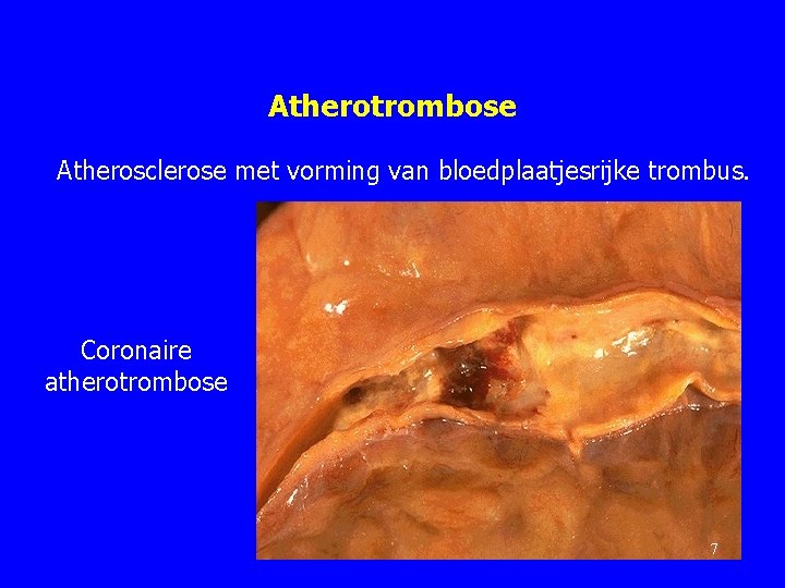 Atherotrombose Atherosclerose met vorming van bloedplaatjesrijke trombus. Coronaire atherotrombose 7 