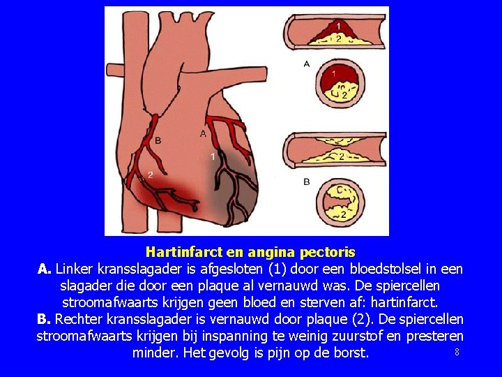 Hartinfarct en angina pectoris A. Linker kransslagader is afgesloten (1) door een bloedstolsel in