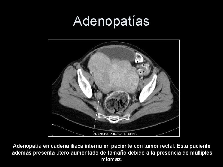 Adenopatías Adenopatía en cadena iliaca interna en paciente con tumor rectal. Esta paciente además