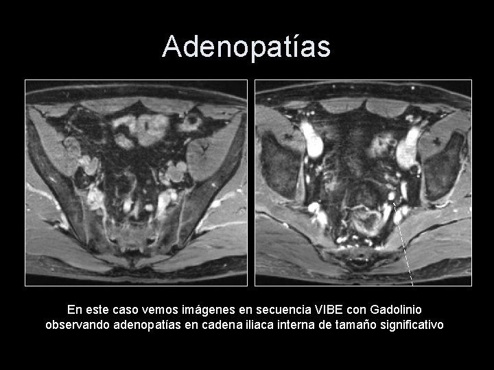 Adenopatías En este caso vemos imágenes en secuencia VIBE con Gadolinio observando adenopatías en