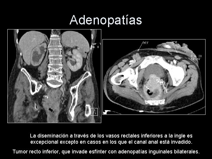 Adenopatías La diseminación a través de los vasos rectales inferiores a la ingle es