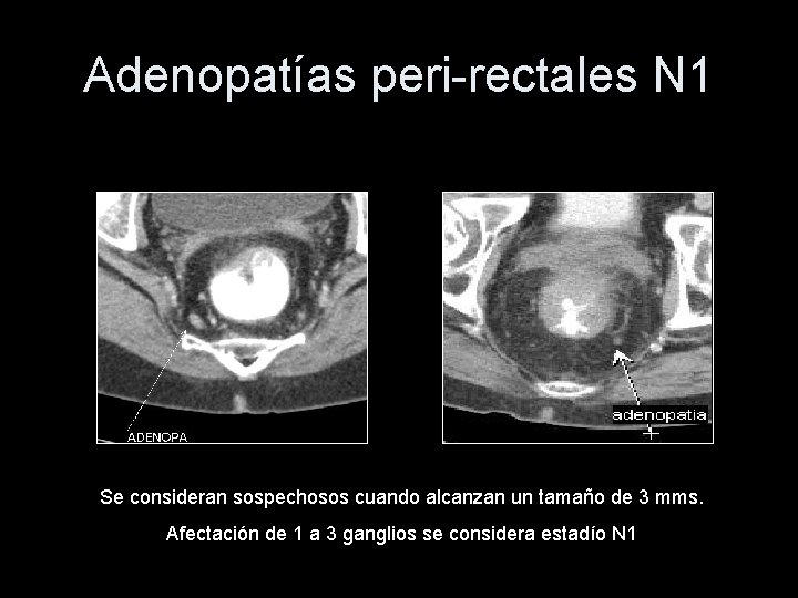 Adenopatías peri-rectales N 1 Se consideran sospechosos cuando alcanzan un tamaño de 3 mms.