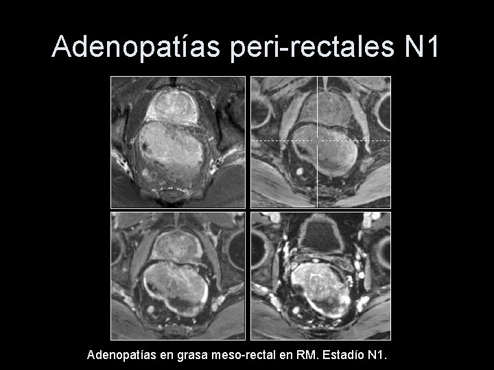 Adenopatías peri-rectales N 1 Adenopatías en grasa meso-rectal en RM. Estadío N 1. 