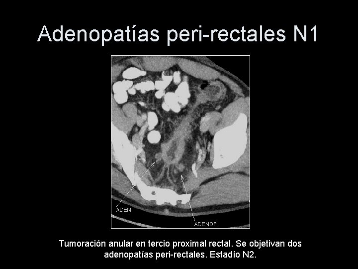 Adenopatías peri-rectales N 1 Tumoración anular en tercio proximal rectal. Se objetivan dos adenopatías
