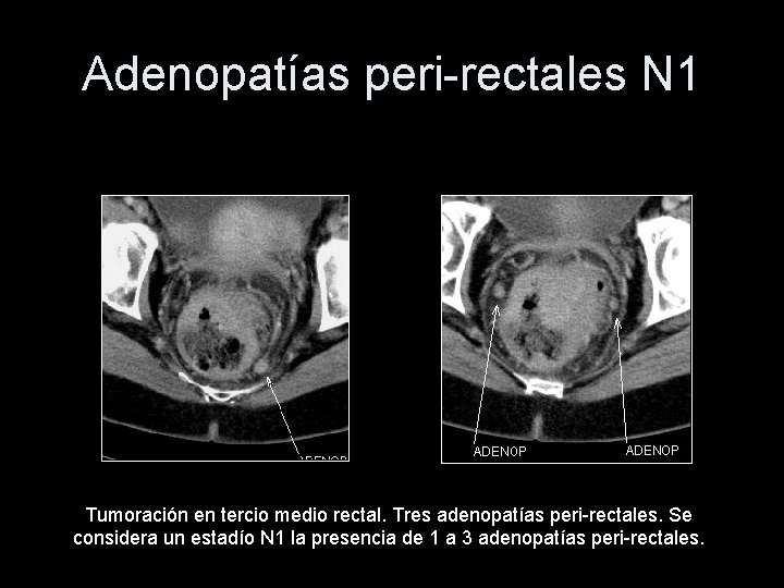 Adenopatías peri-rectales N 1 Tumoración en tercio medio rectal. Tres adenopatías peri-rectales. Se considera