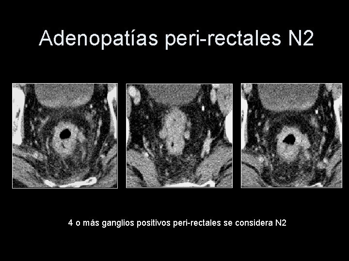 Adenopatías peri-rectales N 2 4 o más ganglios positivos peri-rectales se considera N 2