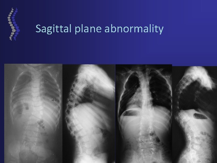 Sagittal plane abnormality 