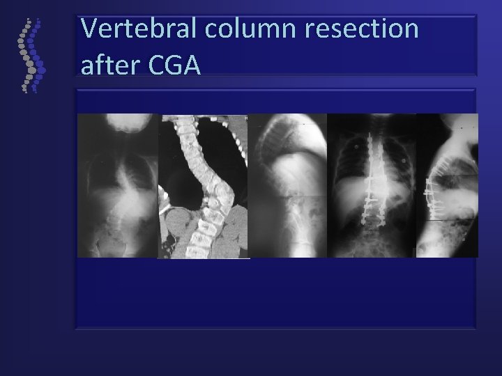 Vertebral column resection after CGA 