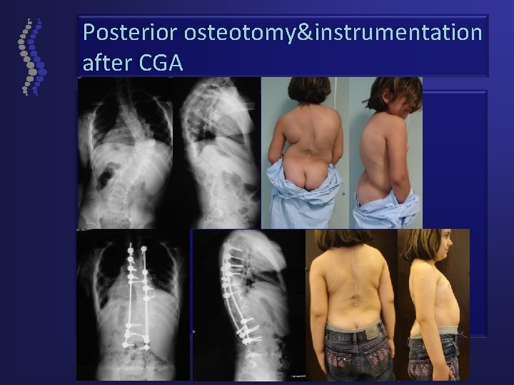 Posterior osteotomy&instrumentation after CGA 