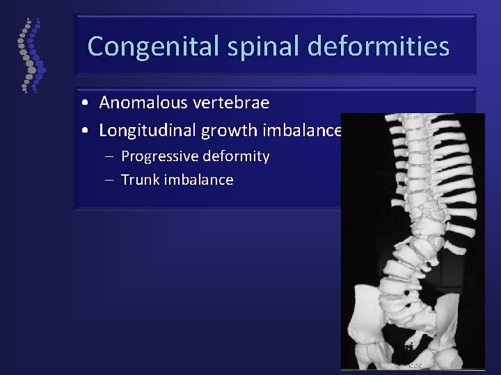 Congenital spinal deformities • Anomalous vertebrae • Longitudinal growth imbalance – Progressive deformity –