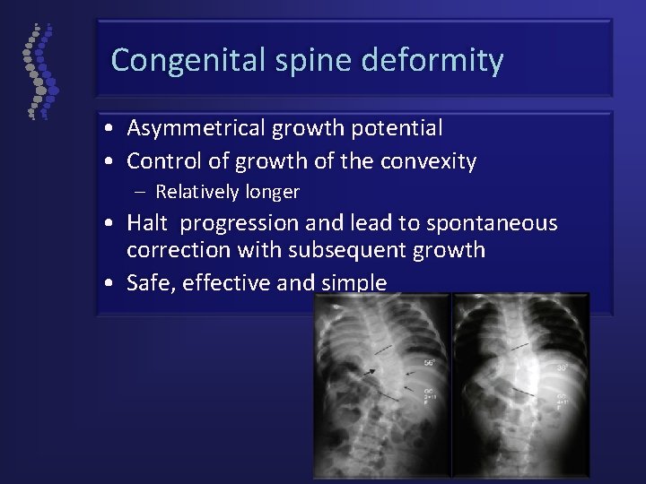 Congenital spine deformity • Asymmetrical growth potential • Control of growth of the convexity
