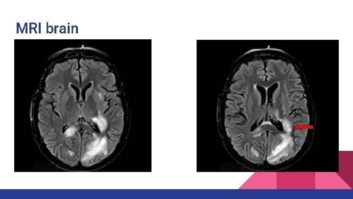MRI brain MRI brain