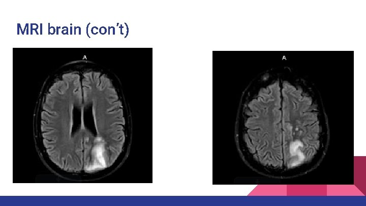 MRI brain (con’t) MRI brain (con’t)