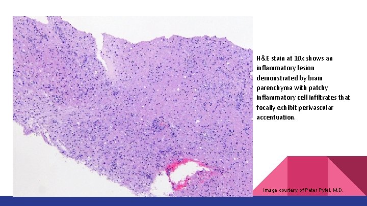 H&E stain at 10 x shows an inflammatory lesion demonstrated by brain parenchyma with H&E stain at 10 x shows an inflammatory lesion demonstrated by brain parenchyma with