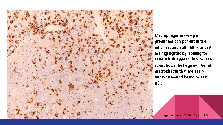 Macrophages make up a prominent component of the inflammatory cell infiltrates and are highlighted Macrophages make up a prominent component of the inflammatory cell infiltrates and are highlighted
