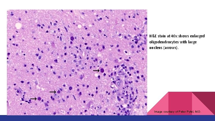 H&E stain at 40 x shows enlarged oligodendrocytes with large nucleus (arrows). Image courtesy H&E stain at 40 x shows enlarged oligodendrocytes with large nucleus (arrows). Image courtesy