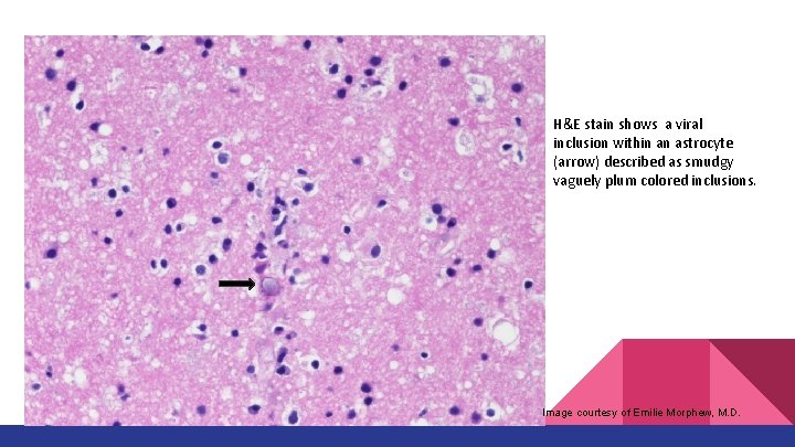 H&E stain shows a viral inclusion within an astrocyte (arrow) described as smudgy vaguely H&E stain shows a viral inclusion within an astrocyte (arrow) described as smudgy vaguely