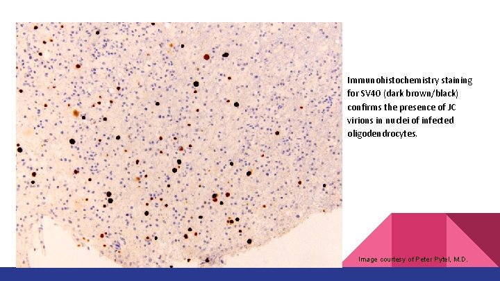 Immunohistochemistry staining for SV 40 (dark brown/black) confirms the presence of JC virions in Immunohistochemistry staining for SV 40 (dark brown/black) confirms the presence of JC virions in