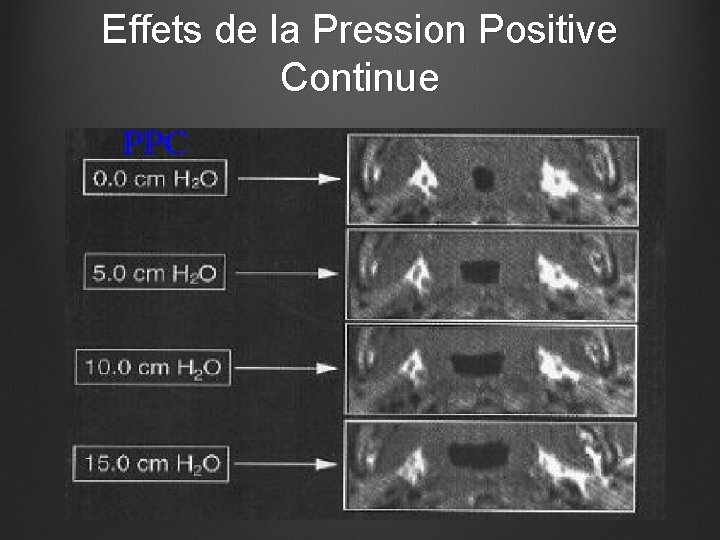Les Traitements du SAS 1 Syndrome dApnees Hypopnes
