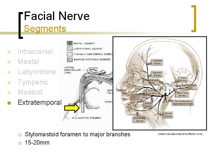 Facial Nerve Segments n n n Intracranial Meatal Labyrinthine Tympanic Mastoid Extratemporal ¡ ¡