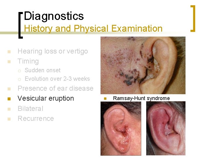Diagnostics History and Physical Examination n n Hearing loss or vertigo Timing ¡ ¡