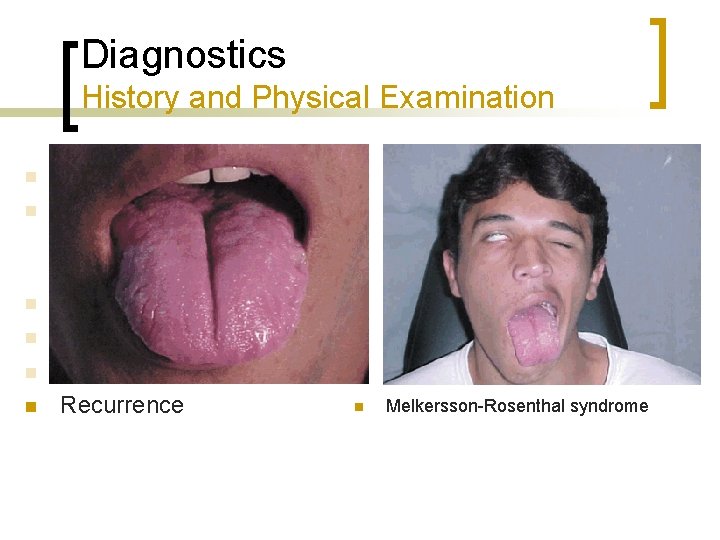 Diagnostics History and Physical Examination n n Hearing loss or vertigo Timing ¡ ¡