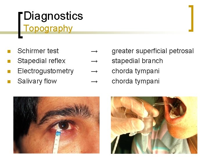 Diagnostics Topography n n Schirmer test Stapedial reflex Electrogustometry Salivary flow → → greater