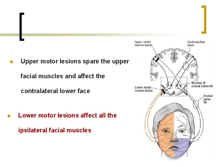 n Upper motor lesions spare the upper facial muscles and affect the contralateral lower