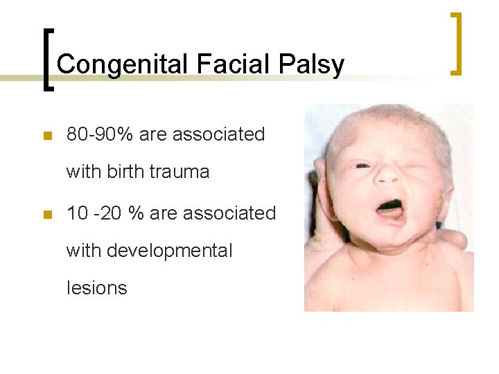 Congenital Facial Palsy n 80 -90% are associated with birth trauma n 10 -20