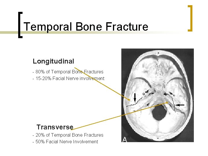 Temporal Bone Fracture Longitudinal - 80% of Temporal Bone Fractures - 15 -20% Facial