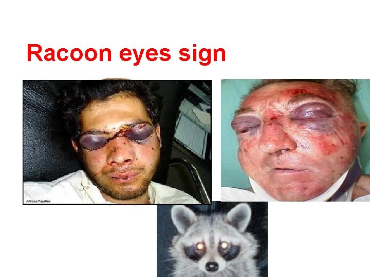 Racoon eyes sign 