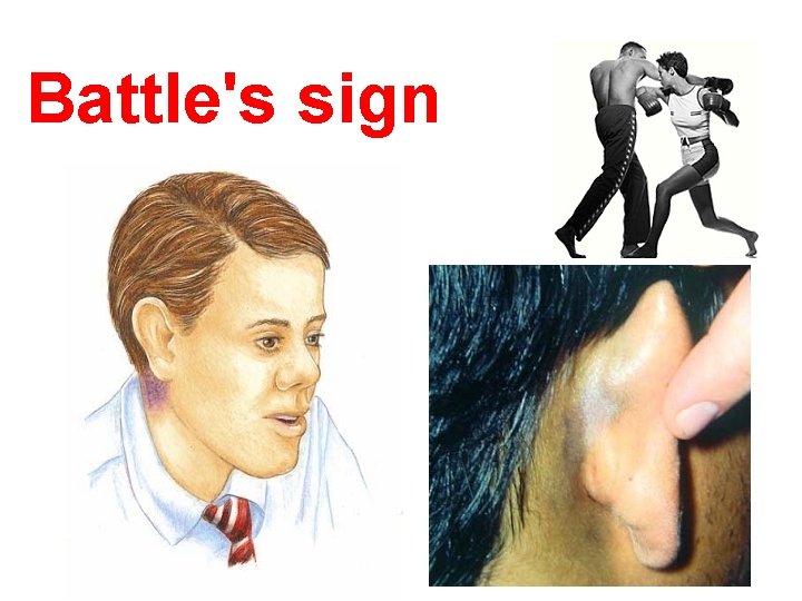 Battle's sign 