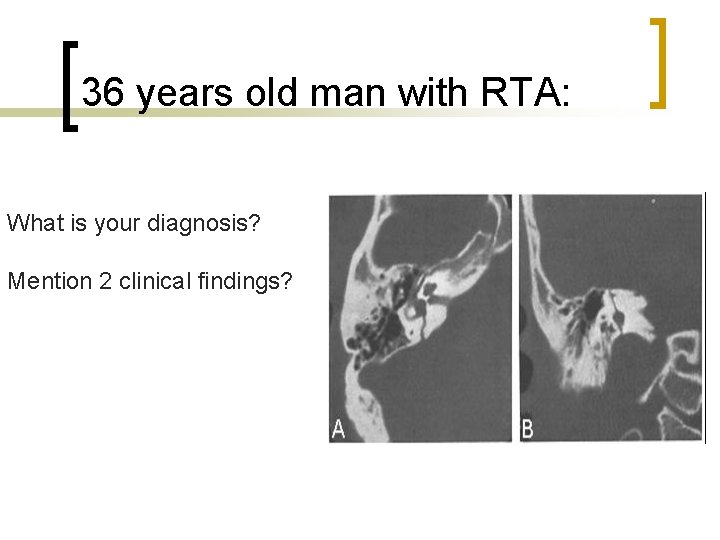 36 years old man with RTA: What is your diagnosis? Mention 2 clinical findings?