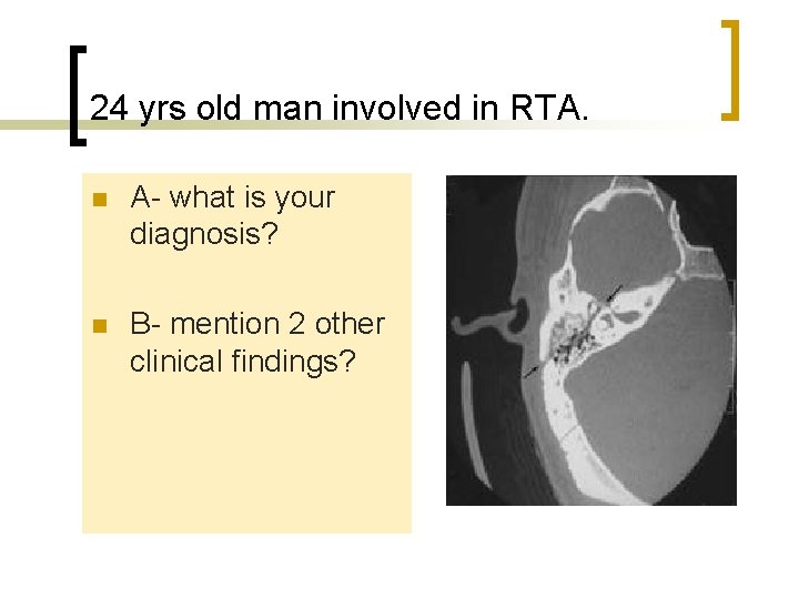 24 yrs old man involved in RTA. n A- what is your diagnosis? n