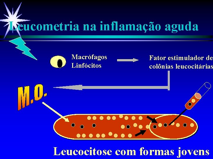 Leucometria na inflamação aguda Macrófagos Linfócitos Fator estimulador de colônias leucocitárias Leucocitose com formas