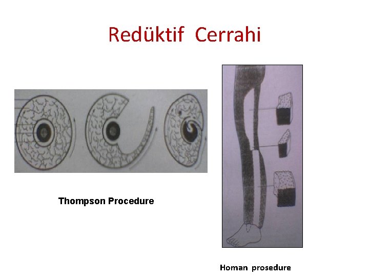 Redüktif Cerrahi Thompson Procedure Homan prosedure 