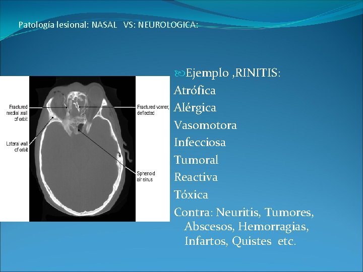 Patología lesional: NASAL VS: NEUROLOGICA: Ejemplo , RINITIS: Atrófica Alérgica Vasomotora Infecciosa Tumoral Reactiva
