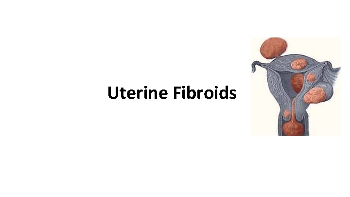 Uterine Fibroids 