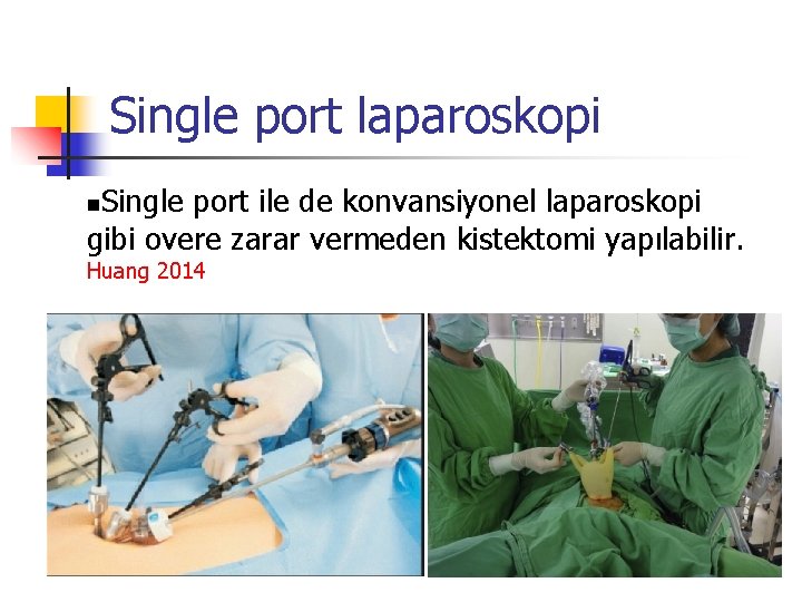 Single port laparoskopi Single port ile de konvansiyonel laparoskopi gibi overe zarar vermeden kistektomi