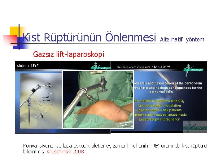 Kist Rüptürünün Önlenmesi Alternatif yöntem Gazsız lift-laparoskopi Konvansiyonel ve laparoskopik aletler eş zamanlı kullunılır.