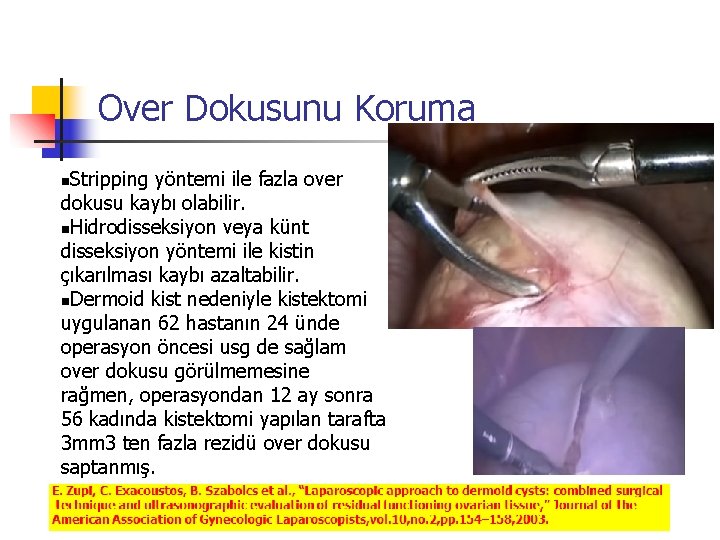 Over Dokusunu Koruma Stripping yöntemi ile fazla over dokusu kaybı olabilir. Hidrodisseksiyon veya künt