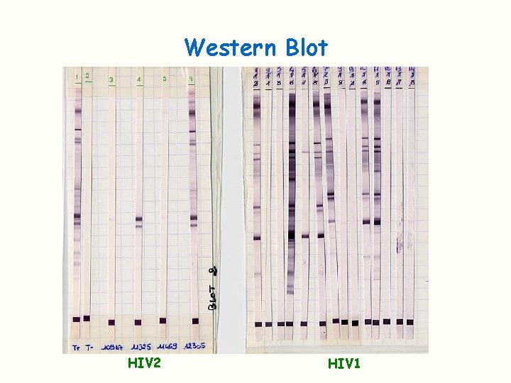 Western Blot HIV 2 HIV 1 