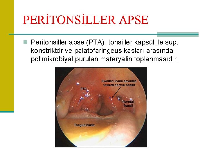 PERİTONSİLLER APSE n Peritonsiller apse (PTA), tonsiller kapsül ile sup. konstriktör ve palatofaringeus kasları