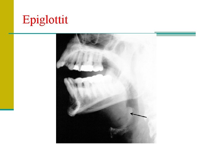 Epiglottit 