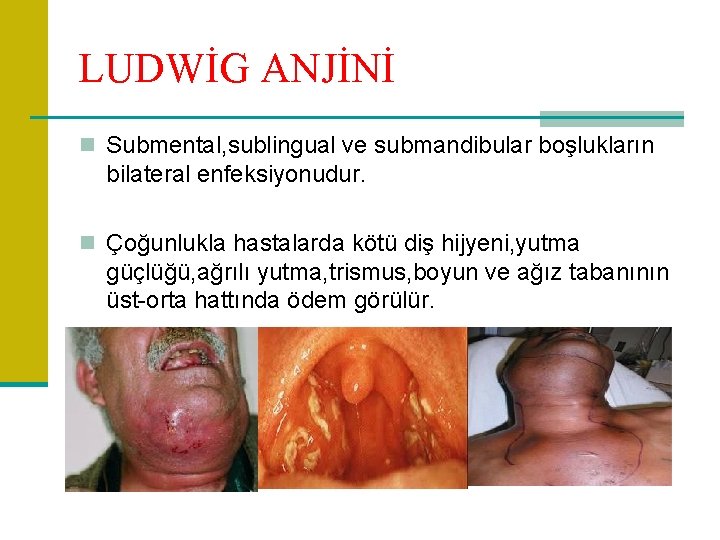 LUDWİG ANJİNİ n Submental, sublingual ve submandibular boşlukların bilateral enfeksiyonudur. n Çoğunlukla hastalarda kötü