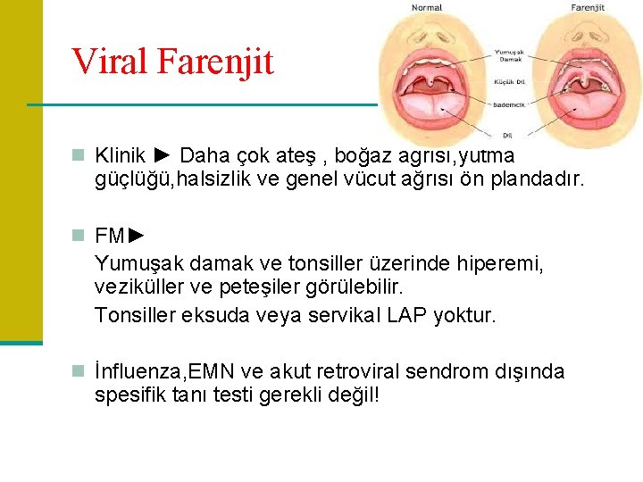 Viral Farenjit n Klinik ► Daha çok ateş , boğaz ağrısı, yutma güçlüğü, halsizlik