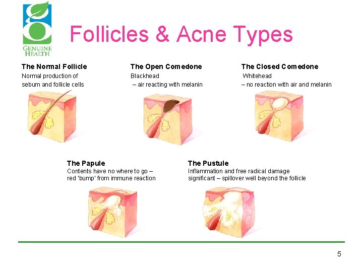 Follicles & Acne Types The Normal Follicle The Open Comedone Normal production of sebum Follicles & Acne Types The Normal Follicle The Open Comedone Normal production of sebum
