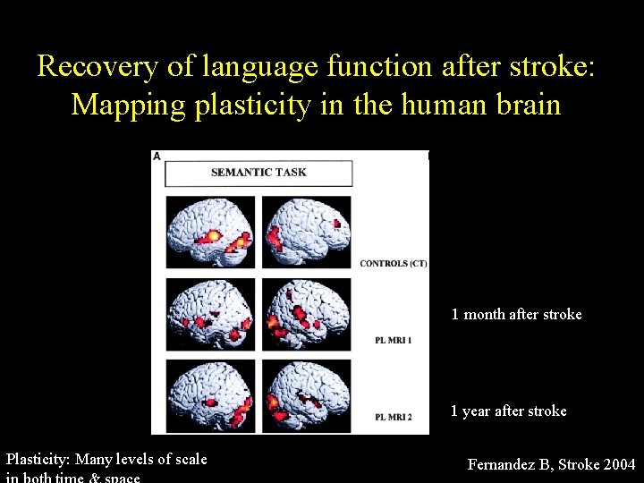 Recovery of language function after stroke: Mapping plasticity in the human brain 1 month